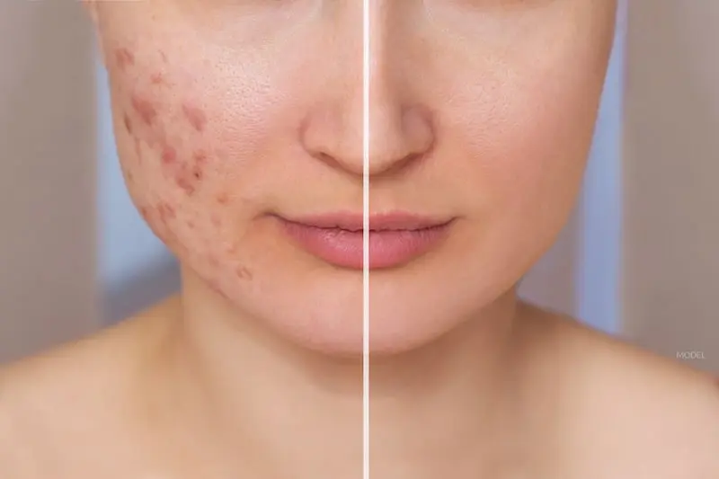 Acne Management