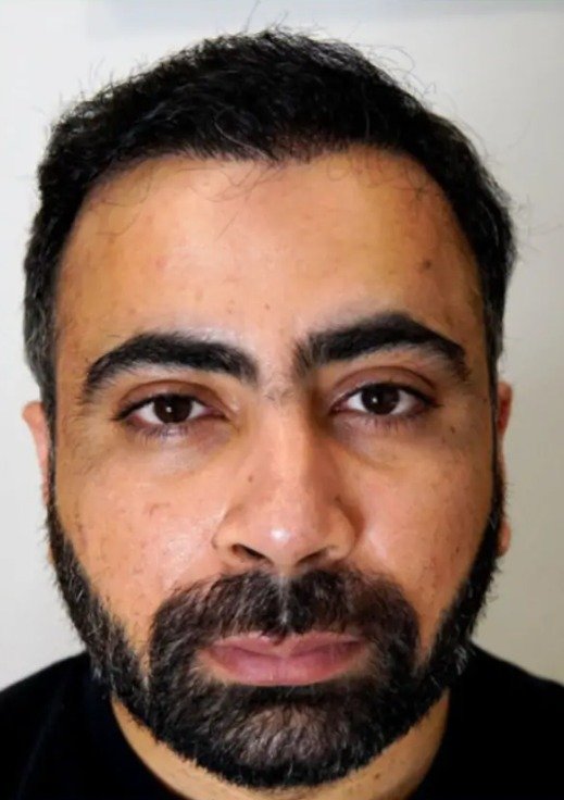 After Hair Transplant