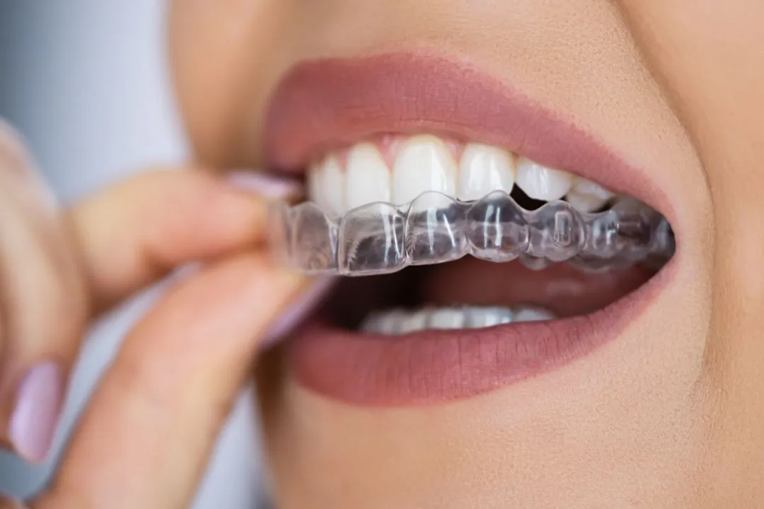 Braces & Invisalign Aligners