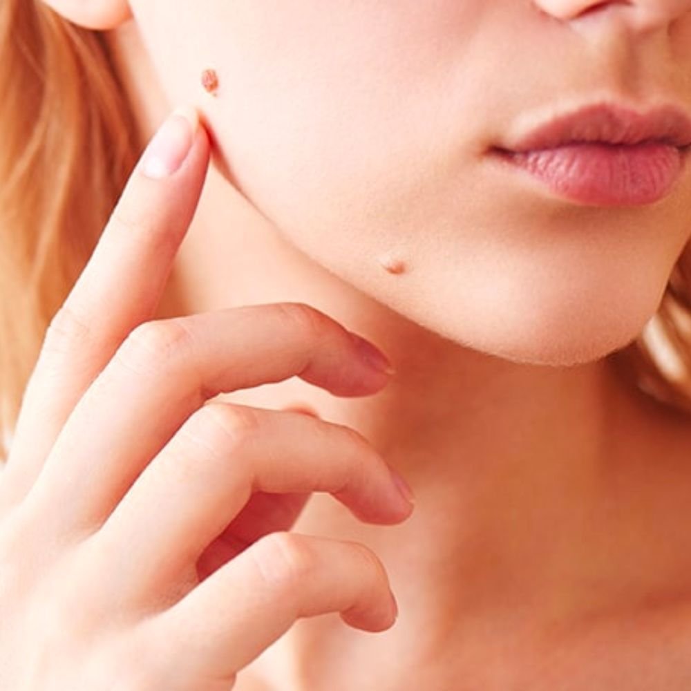 Mole Removal