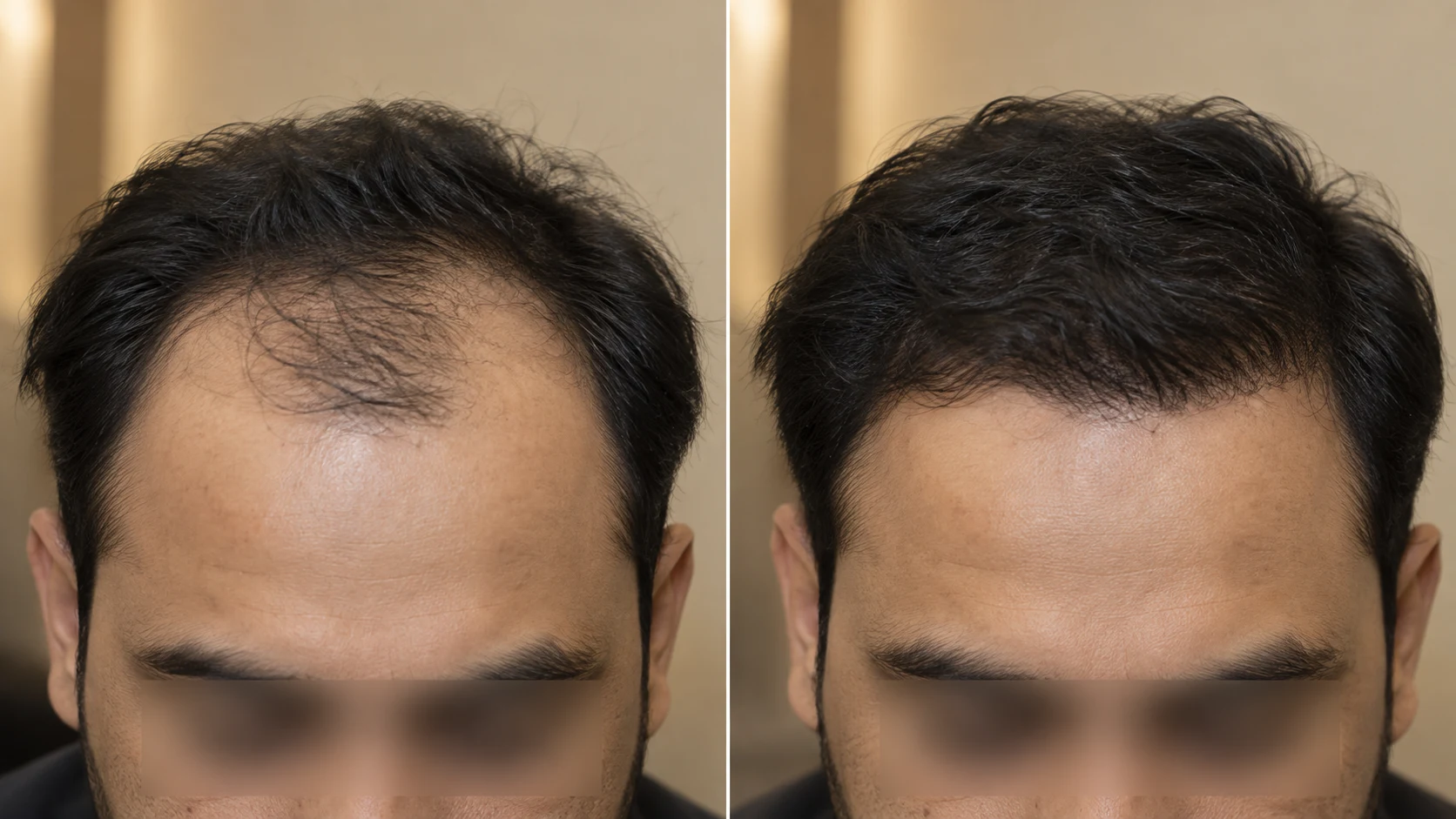 FUE hair transplant before and after result in Karachi